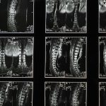 chiropractic relief for sciatica