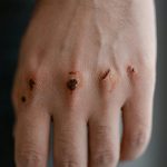 rf treatment safety guidelines